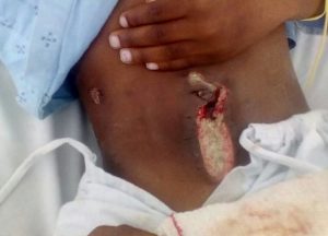 Anger as KZN hospital sends child home with gaping wound