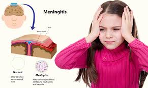 AT least 40 pupils as well as doctors, nurses and teachers in Amanzimtoti have been placed on antibiotics to prevent them from contracting a “very infectious” strain of meningitis following the death of a 7-year-old boy last week.